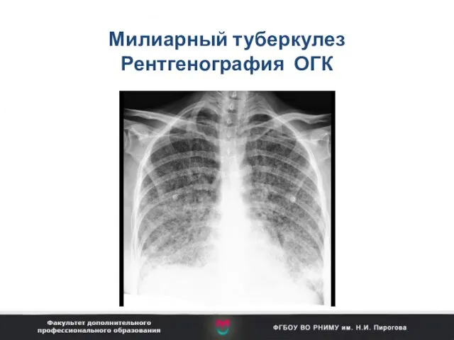 Милиарный туберкулез Рентгенография ОГК