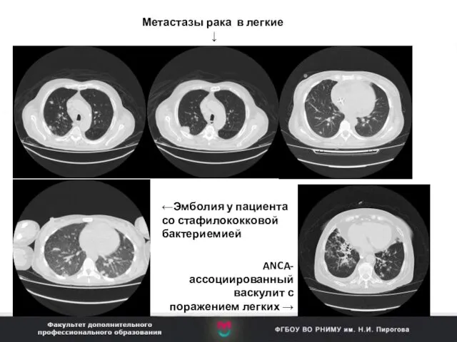 Метастазы рака в легкие ↓ ←Эмболия у пациента со стафилококковой