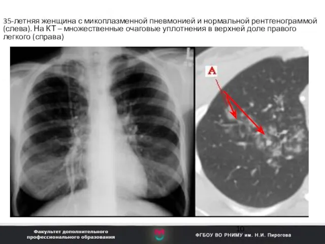35-летняя женщина с микоплазменной пневмонией и нормальной рентгенограммой (слева). На