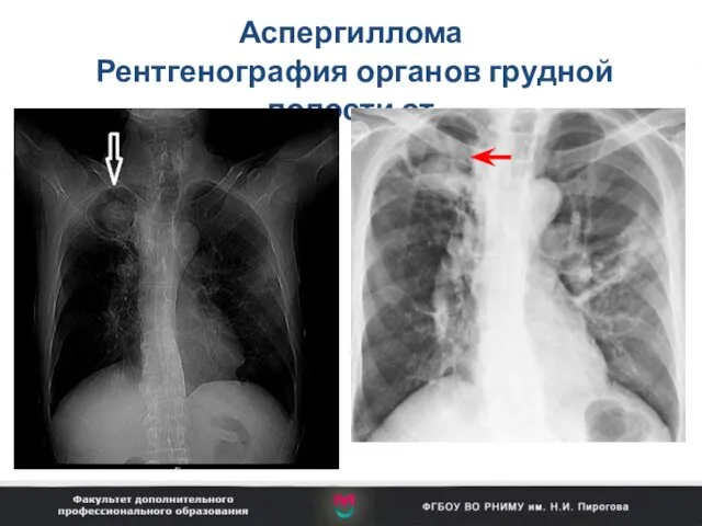 Аспергиллома Рентгенография органов грудной полости от