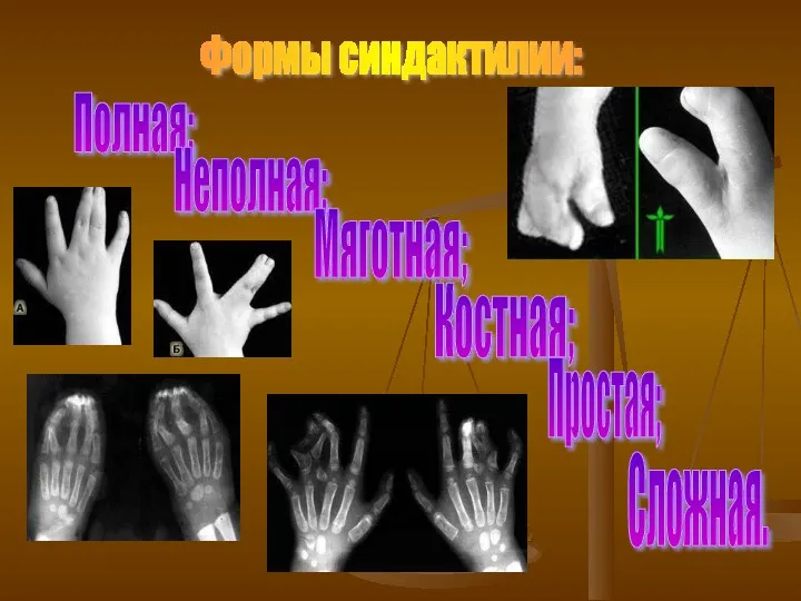 Формы синдактилии: Полная; Неполная; Мяготная; Костная; Простая; Сложная.