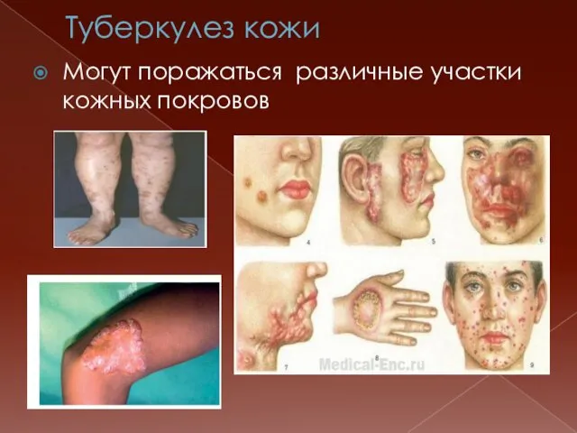 Туберкулез кожи Могут поражаться различные участки кожных покровов
