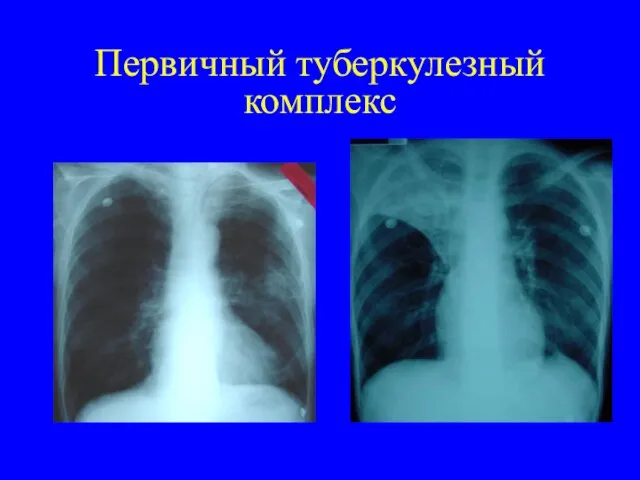 Первичный туберкулезный комплекс