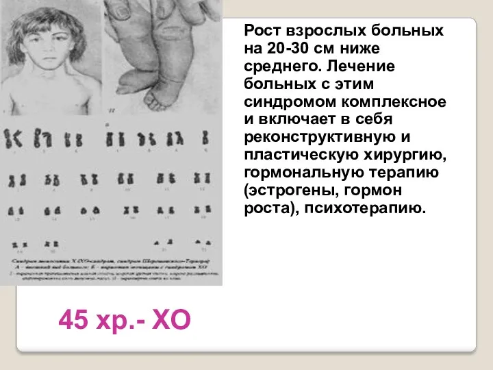 45 хр.- ХО Рост взрослых больных на 20-30 см ниже среднего. Лечение больных