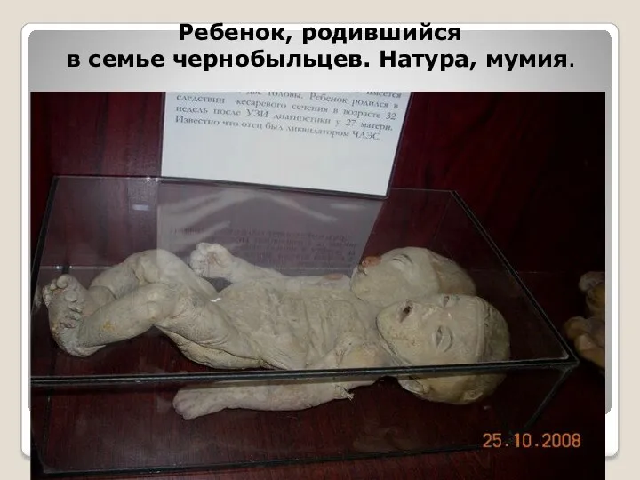 Ребенок, родившийся в семье чернобыльцев. Натура, мумия.