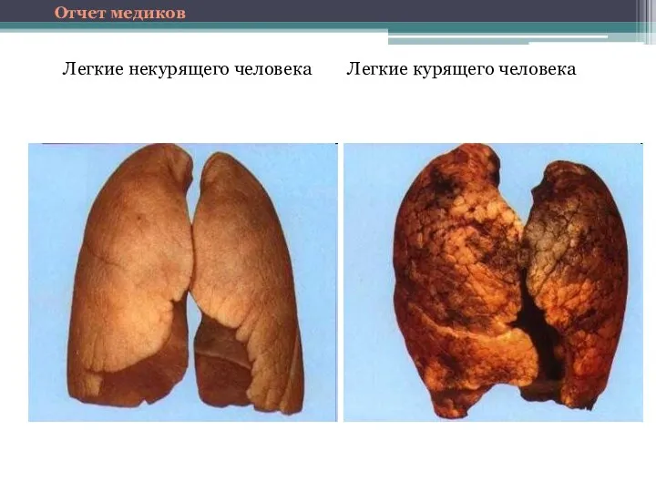 Легкие курящего человека Легкие некурящего человека Отчет медиков