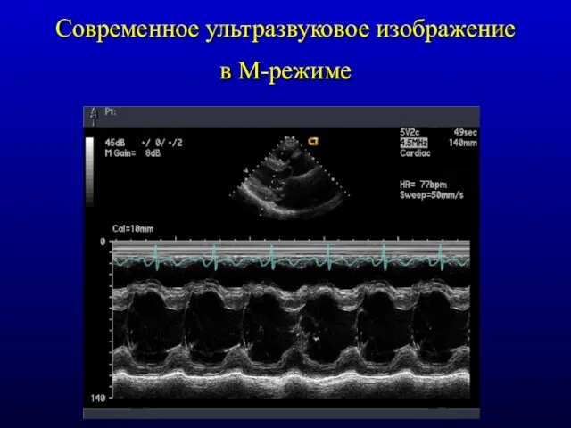 Современное ультразвуковое изображение в М-режиме