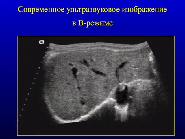 Современное ультразвуковое изображение в В-режиме