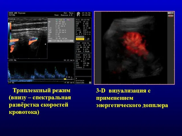 Триплексный режим (внизу – спектральная развёрстка скоростей кровотока) 3-D визуализация с применением энергетического допплера
