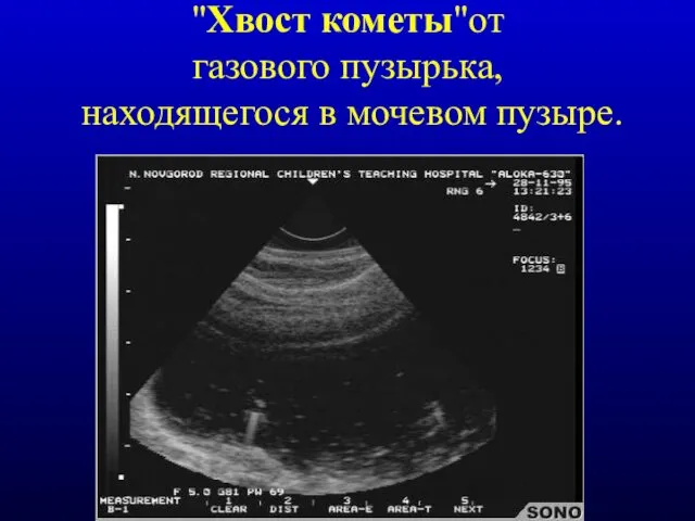 "Хвост кометы"от газового пузырька, находящегося в мочевом пузыре.