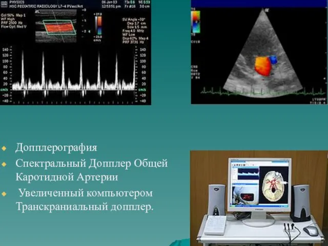 Допплерография Спектральный Допплер Общей Каротидной Артерии Увеличенный компьютером Транскраниальный допплер.