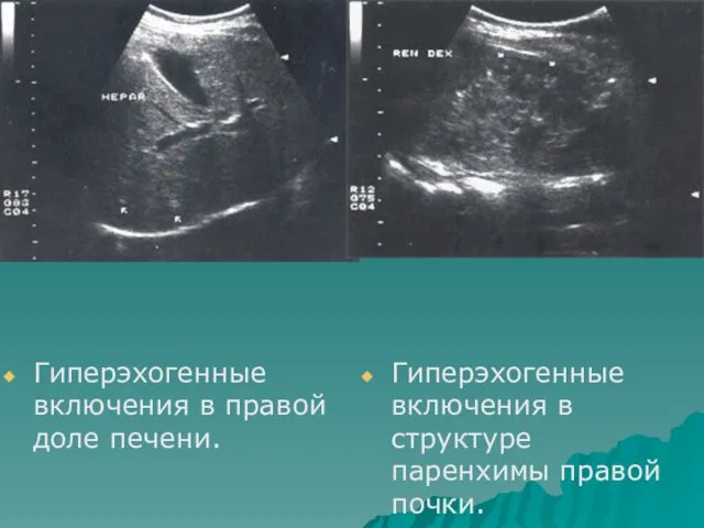 Гиперэхогенные включения в правой доле печени. Гиперэхогенные включения в структуре паренхимы правой почки.