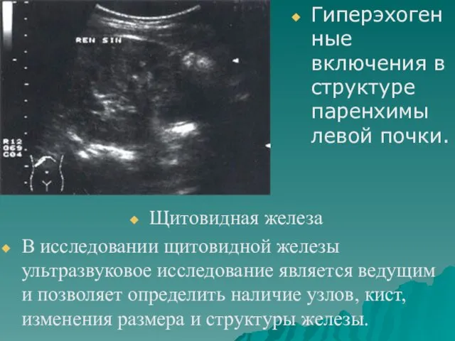 Гиперэхогенные включения в структуре паренхимы левой почки. Щитовидная железа В