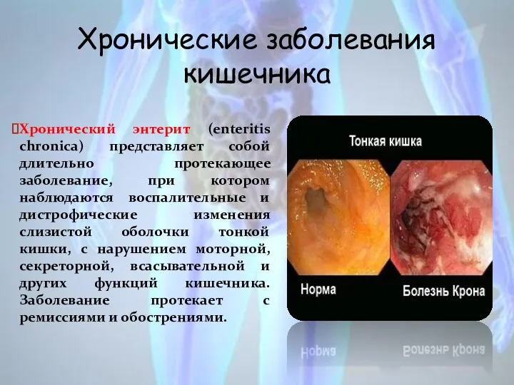 Хронические заболевания кишечника Хронический энтерит (enteritis chronica) представляет собой длительно