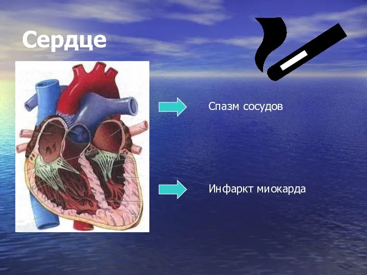 Сердце Спазм сосудов Инфаркт миокарда