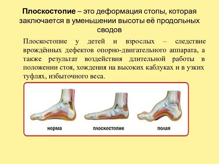 Плоскостопие – это деформация стопы, которая заключается в уменьшении высоты