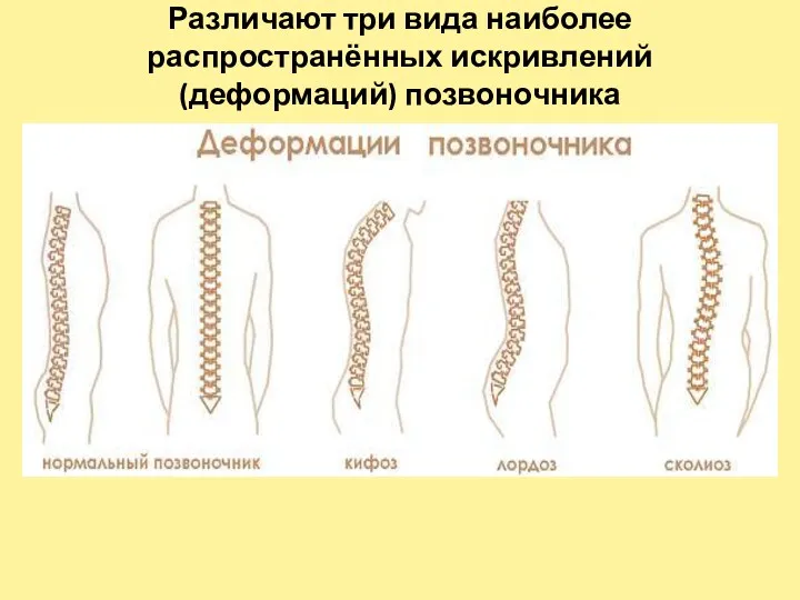 Различают три вида наиболее распространённых искривлений (деформаций) позвоночника