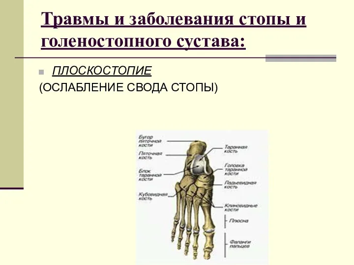 Травмы и заболевания стопы и голеностопного сустава: ПЛОСКОСТОПИЕ (ОСЛАБЛЕНИЕ СВОДА СТОПЫ)