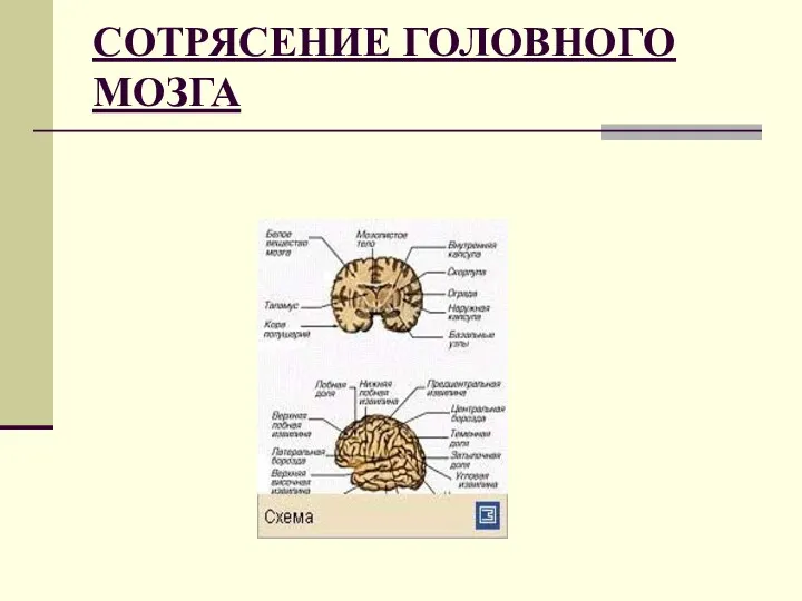 СОТРЯСЕНИЕ ГОЛОВНОГО МОЗГА