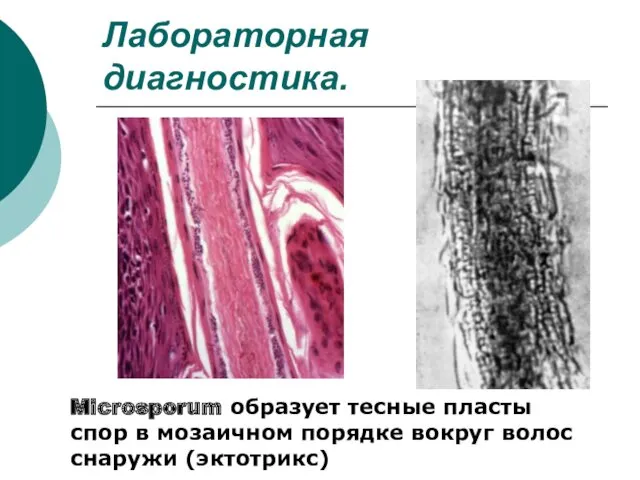 Лабораторная диагностика. Microsporum образует тесные пласты спор в мозаичном порядке вокруг волос снаружи (эктотрикс)