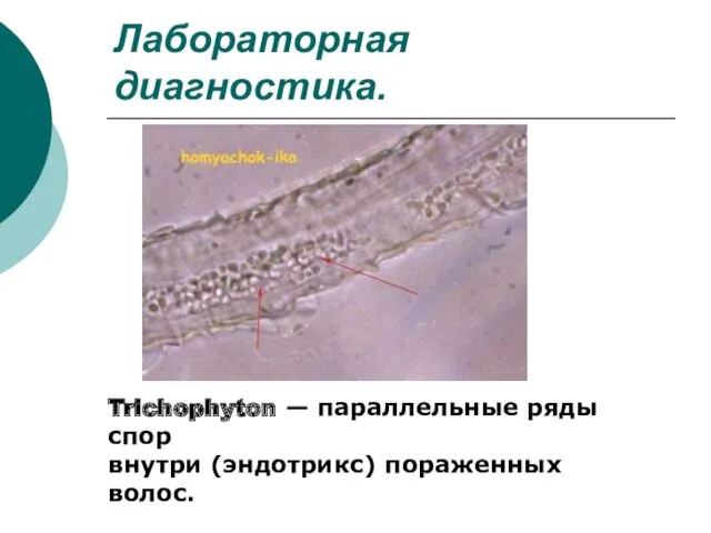 Лабораторная диагностика. Trichophyton — параллельные ряды спор внутри (эндотрикс) пораженных волос.