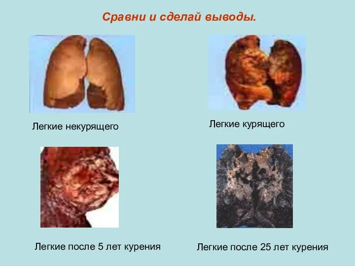 Сравни и сделай выводы. Легкие некурящего Легкие курящего Легкие после