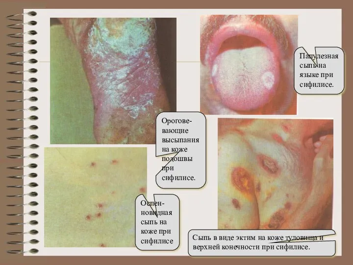 Орогове-вающие высыпания на коже подошвы при сифилисе. Оспен-новидная сыпь на
