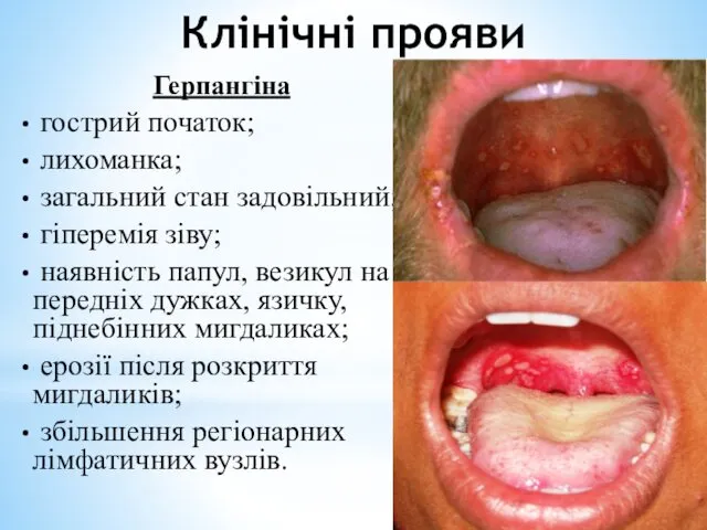 Клінічні прояви Герпангіна гострий початок; лихоманка; загальний стан задовільний; гіперемія