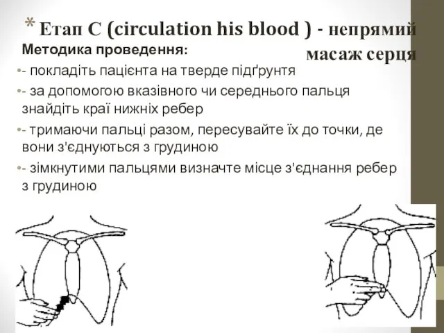 Етап С (circulation his blood ) - непрямий масаж серця
