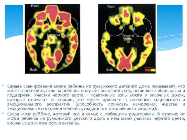 Справа сканирование мозга ребёнка из румынского детского дома показывает, что