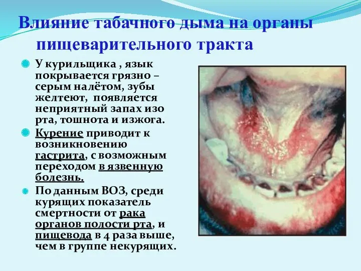Влияние табачного дыма на органы пищеварительного тракта У курильщика , язык покрывается грязно