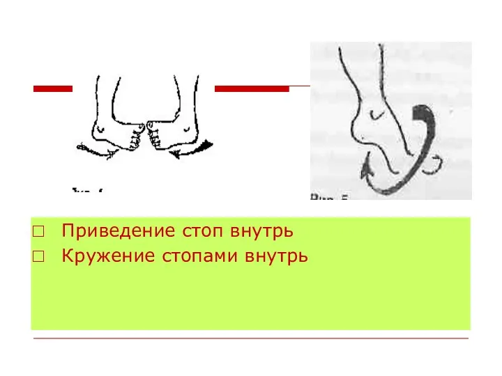 Приведение стоп внутрь Кружение стопами внутрь