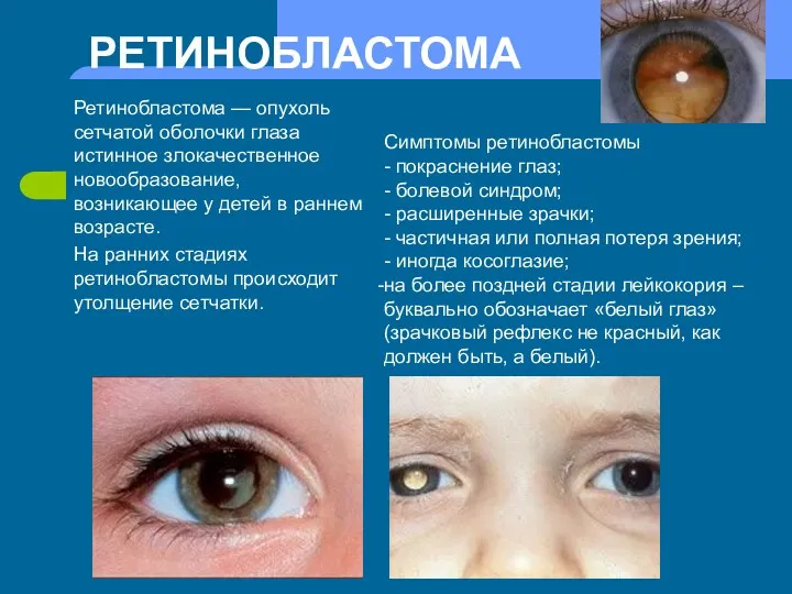 Ретинобластома Ретинобластома — опухоль сетчатой оболочки глаза истинное злокачественное новообразование,