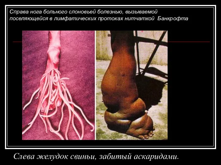Слева желудок свиньи, забитый аскаридами. Справа нога больного слоновьей болезнью,