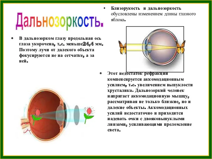 Дальнозоркость.