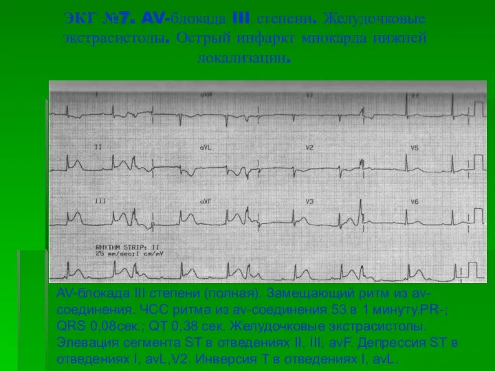 ЭКГ №7. AV-блокада III степени. Желудочковые экстрасистолы. Острый инфаркт миокарда нижней локализации. AV-блокада