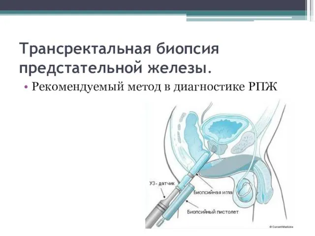 Трансректальная биопсия предстательной железы. Рекомендуемый метод в диагностике РПЖ