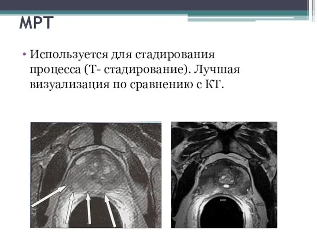 МРТ Используется для стадирования процесса (Т- стадирование). Лучшая визуализация по сравнению с КТ.