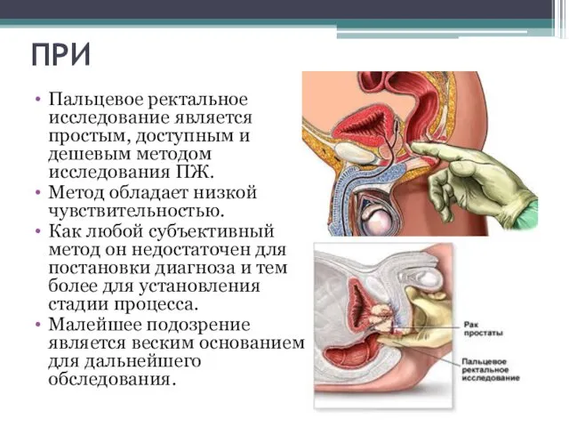 ПРИ Пальцевое ректальное исследование является простым, доступным и дешевым методом