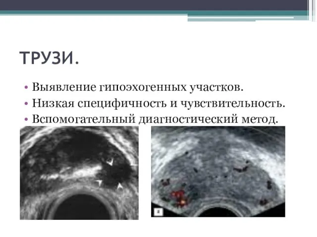 ТРУЗИ. Выявление гипоэхогенных участков. Низкая специфичность и чувствительность. Вспомогательный диагностический метод.