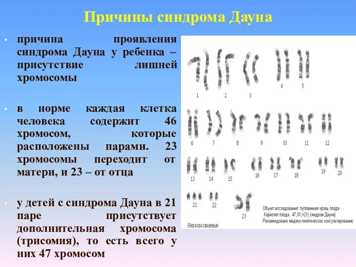 Причины синдрома Дауна причина проявления синдрома Дауна у ребенка – присутствие лишней хромосомы