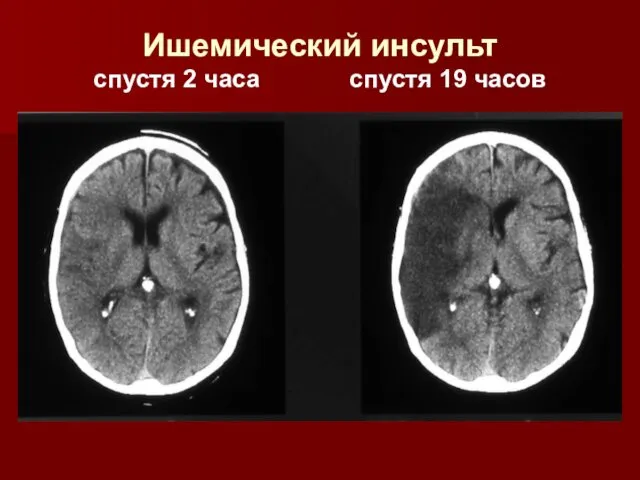 Ишемический инсульт спустя 2 часа спустя 19 часов