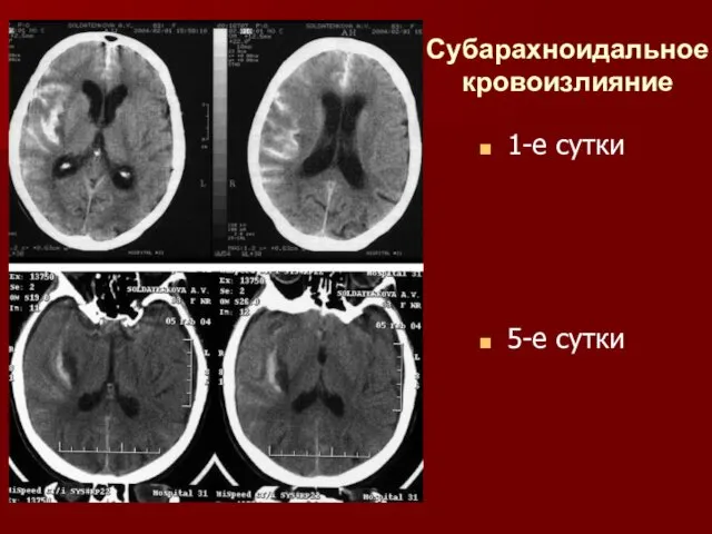 Субарахноидальное кровоизлияние 1-е сутки 5-е сутки