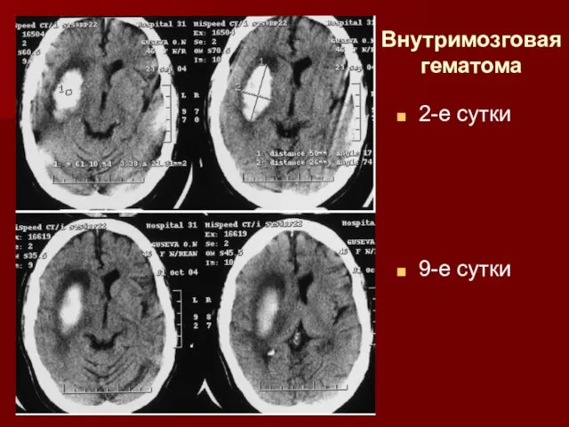 Внутримозговая гематома 2-е сутки 9-е сутки