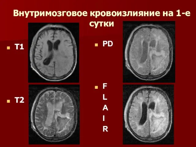 Внутримозговое кровоизлияние на 1-е сутки T1 T2 PD F L A I R