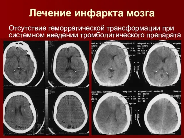 Лечение инфаркта мозга Отсутствие геморрагической трансформации при системном введении тромболитического препарата