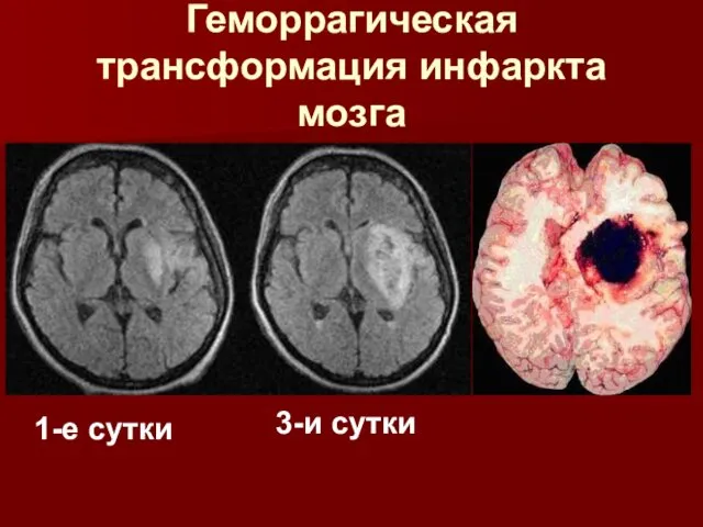 Геморрагическая трансформация инфаркта мозга 1-е сутки 3-и сутки