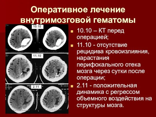 Оперативное лечение внутримозговой гематомы 10.10 – КТ перед операцией; 11.10