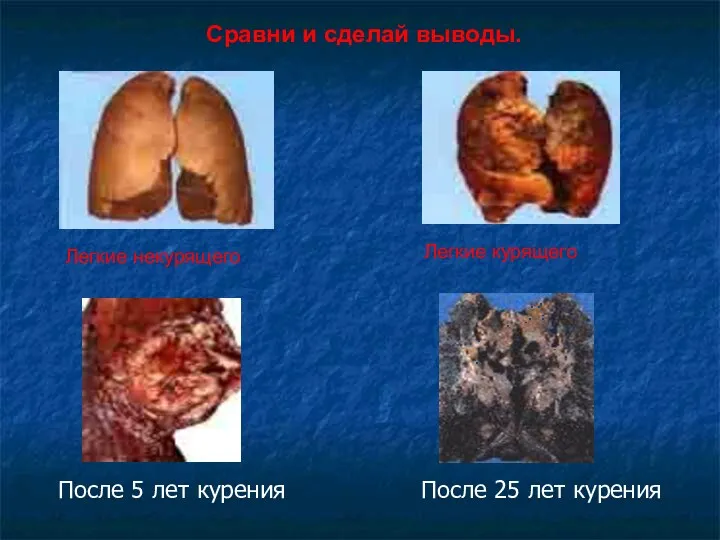 После 5 лет курения После 25 лет курения Сравни и сделай выводы. Легкие некурящего Легкие курящего