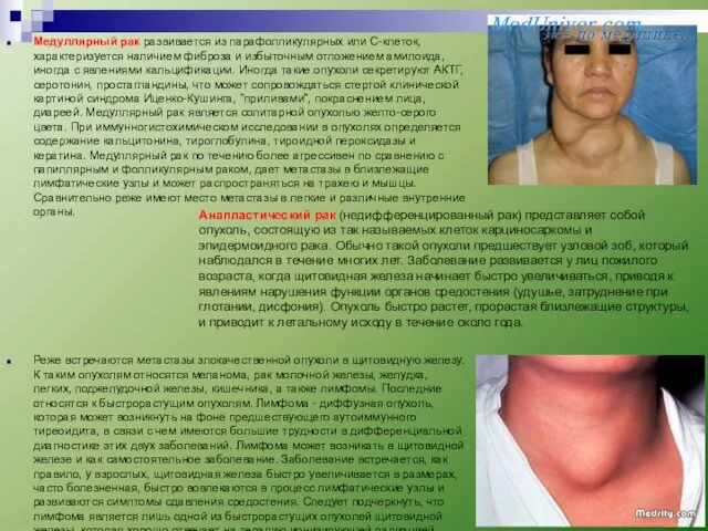 Медуллярный рак развивается из парафолликулярных или С-клеток, характеризуется наличием фиброза